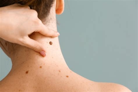 mole and skin tag removal how it works and the healing process