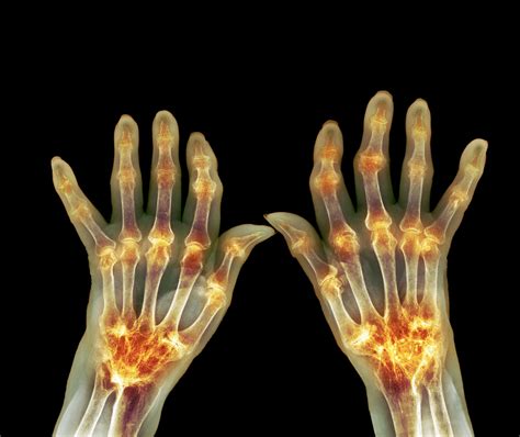 Case Study Cardiac Manifestations Of Rheumatoid Arthritis The