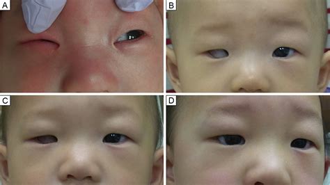 Socket Expansion With Conformers In Congenital Anophthalmia And