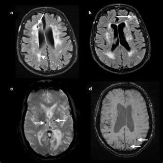 Ct And Mri Examples Of Various Presentations Of White Matter Disease A