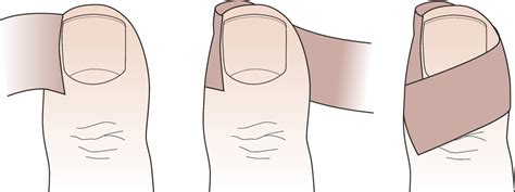 Ingrown Toenail Diagram