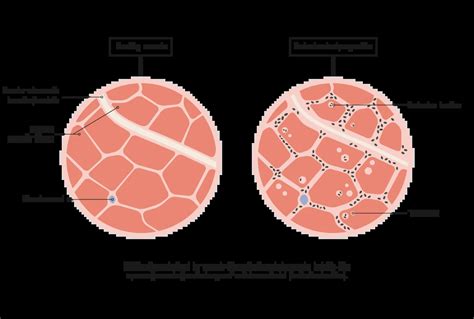 Inclusion Body Myositis Treatment With Stem Cells Swiss Medica