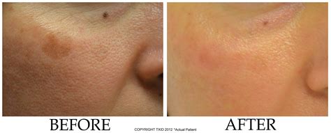 Last Week Addisons Disease Skin Pigmentation Pictures