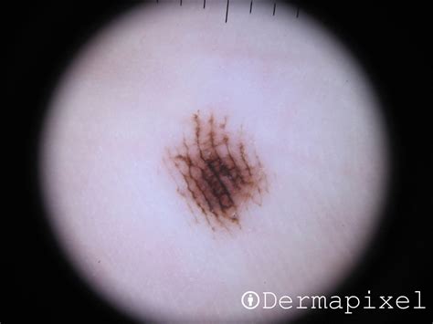 Dermapixel: Tengo una mancha en la planta del pie