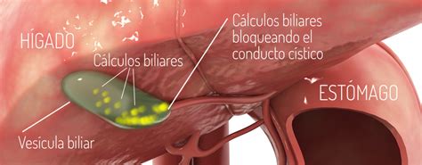 Colelitiasis colecistectomía Obesidad y Diabetes Dr Durán