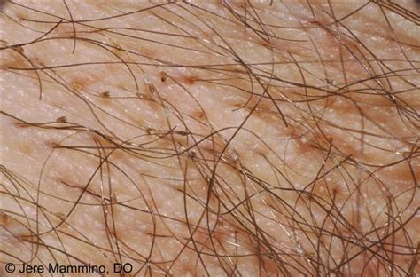 Live intense colour red passion. Pubic Lice - American Osteopathic College of Dermatology ...