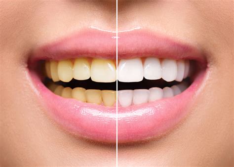 Teeth Whitening After Braces Belmar Orthodontics