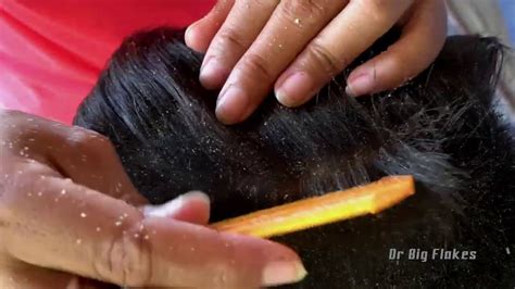 Picking Big Scalp Flakes Psoriasis And Scratching Dandruff With Combing