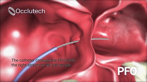 Occlutech Pfo Occluder Occlutech Every Beat Counts