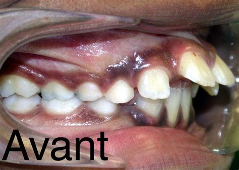 Do you not get them closed for fear of braces?now there is a new technique that can be used to close the spaces without any b. how to fix crooked teeth without braces | Crooked teeth ...