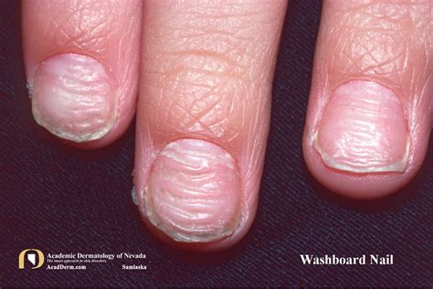 Nail Trauma Washboard Nails Nail Biting Academic Dermatology Of