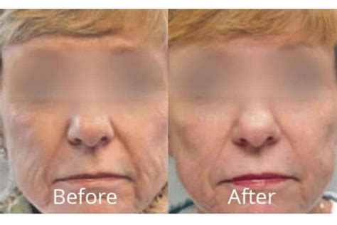 Laser Skin Resurfacing Refine Dermatique Medical Spa