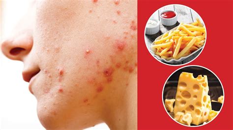 5 Foods That Can Cause Acne Tips To Get Rid Of Acne Femina Wellness