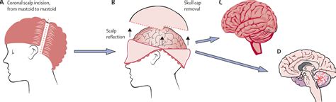 Brain Banking For Neurological Disorders The Lancet Neurology