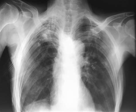 E Chest Radiograph Showing Resolution Of Pneumothorax After ICD