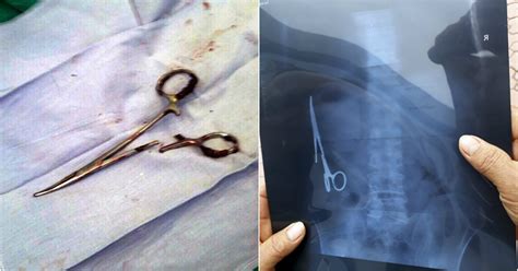 Man Has Scissors Removed From Inside Him After 18 Year Stomach Ache Metro News