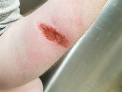 Got This Burn 6 Days Ago Is It Infected Medical