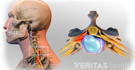 Cervical Herniated Disc Causes And Diagnosis