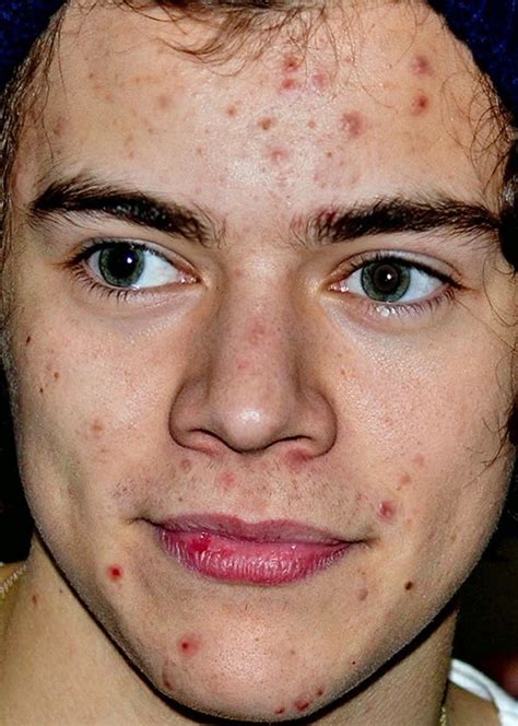 20 Celebrities With Worst Skins Lively Pals Harry Styles Eyes