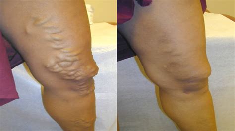 5 Effective Tips Of Varicose Veins Treatment How To Get