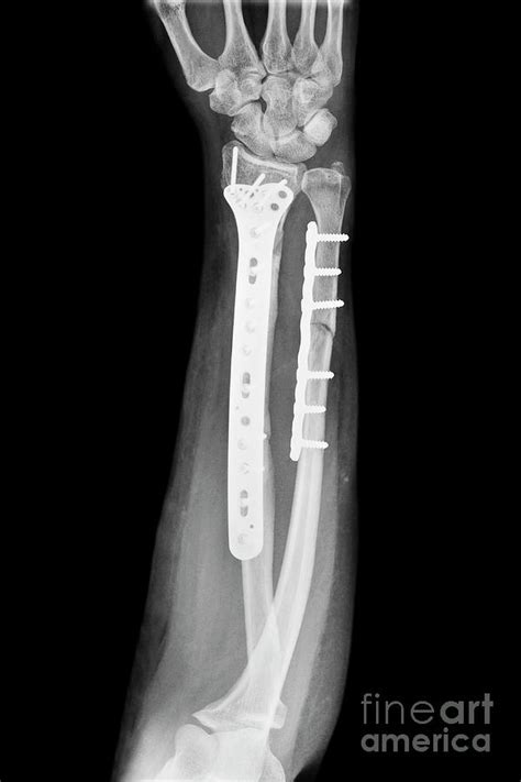 Pinned Fractured Lower Arm Bones Photograph By Science Photo Library