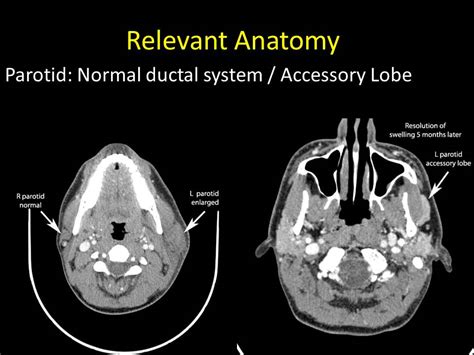 Eustachian Tube Anatomy Anatomical Charts And Posters