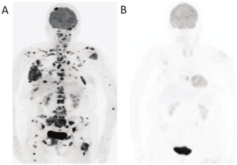 A Pet Scan Demonstrating Abnormal Fdg Uptake In The Right Breast