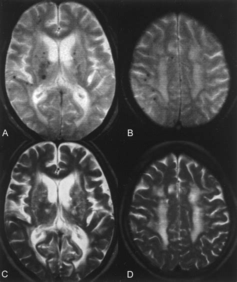 Brain Microhemorrhages Detected On T2 Weighted Gradient Echo Mr Images