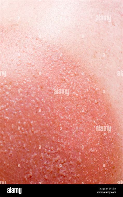 Sunburnt Skin On A Mansshoulders Sunburn Is Caused By Overexposure To