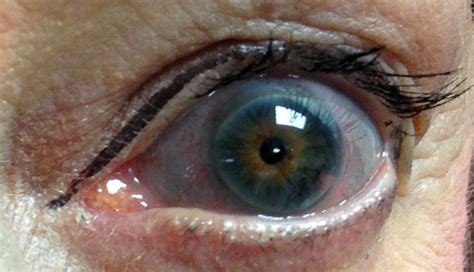 Derm Dx Blue Sclera In A Patient With Skeletal Fractures Clinical