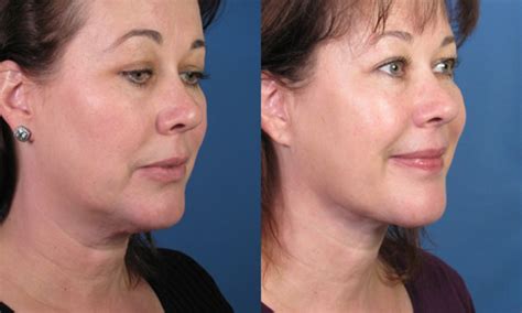 Neck Lift Surgery Cervical Liposuction Platysma Tightening In San Diego Ca