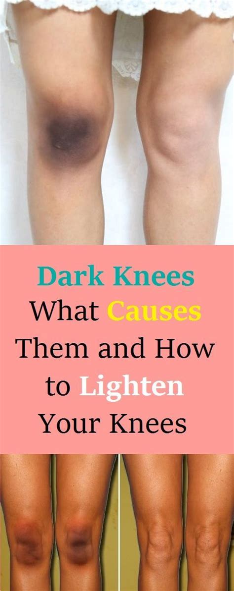 Dark Knees What Causes Them And How To Lighten Your Knees Lighten