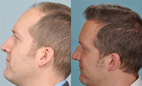 A Testimonial From A Uk Hair Transplant Surgery Patient