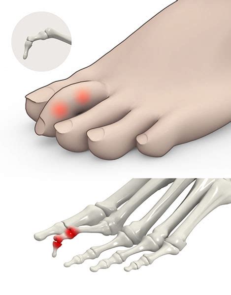 Ankle Ligament Injury River Forest Claw Toe Elmhurst Foot Fracture