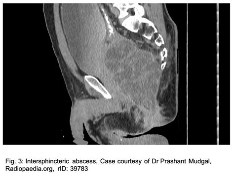 Anorectal Abscesses Ed Clinical Presentation Evaluation And