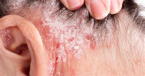 Scalp Psoriasis Everything You Need To Know About Scalp Psoriasis