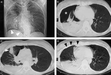 Percutaneous Catheter Drainage Lung Abscess Best Drain Photos