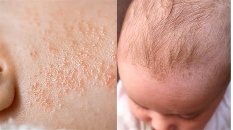 Eczema Vs Other Skin Rashes Understanding The Differences Itchy