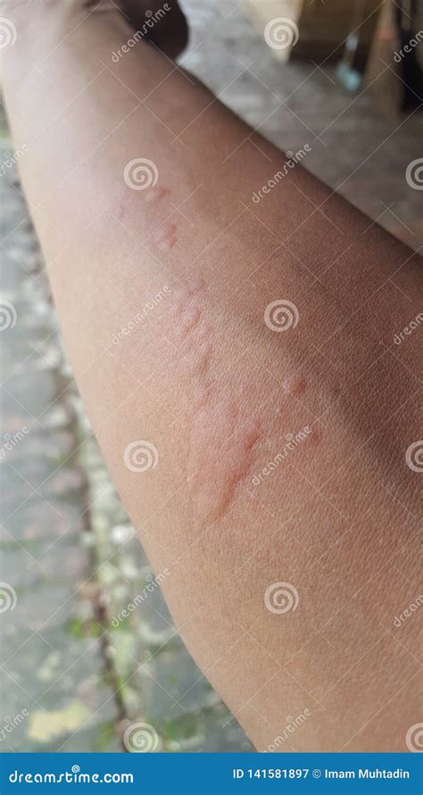 Itchy Bumps On The Skin Due To Insect Bitesitchy Bumps On The Skin Due