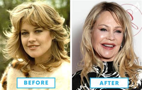 Plastic Surgery Before And After Gone Wrong Plastic Industry In The World