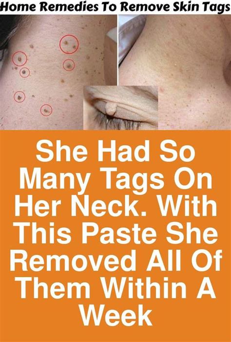 she had so many tags on her neck with this paste she removed all of them within a week today