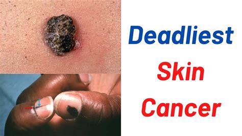 The Deadliest Skin Cancer Youtube