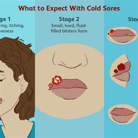 Stages Of Cold Sores On Lips