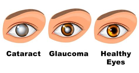 Glaucoma Vs Cataracts Vision Галерија слика