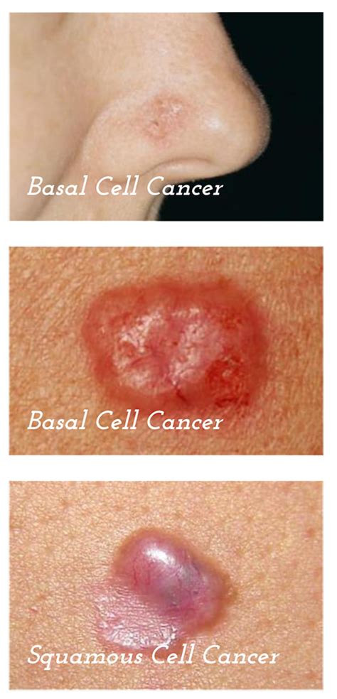 What Does Skin Cancer Feel Like Cancerwalls