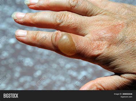 Large Blister On Image And Photo Free Trial Bigstock