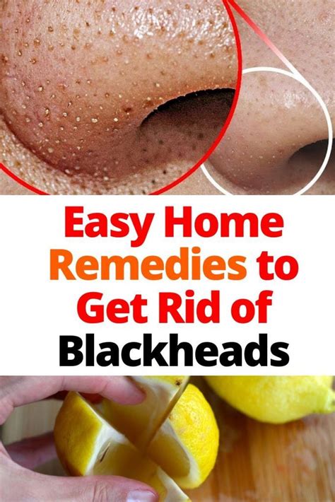 Easy Home Remedies To Get Rid Of Blackheads How To Be Fit In 2020