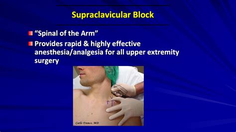 VIDEO Is The Supraclavicular Plexus Block The Right Choice To Prevent Postoperative Pain