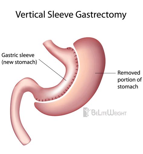 gastric sleeve surgery beliteweight