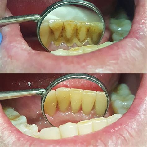 Calculus Deposits Around Bottom Anterior Teeth Before And After A